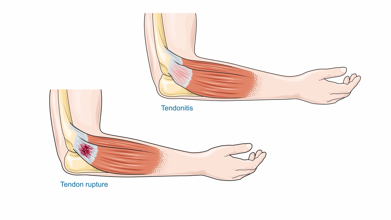 Medical illustration comparing healthy tendon with damaged, degenerated tendon tissue
